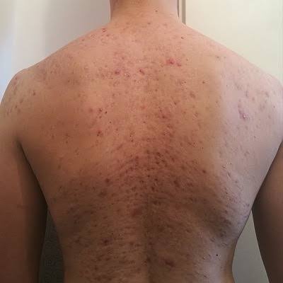 Close-up of a back showing texture and breakouts